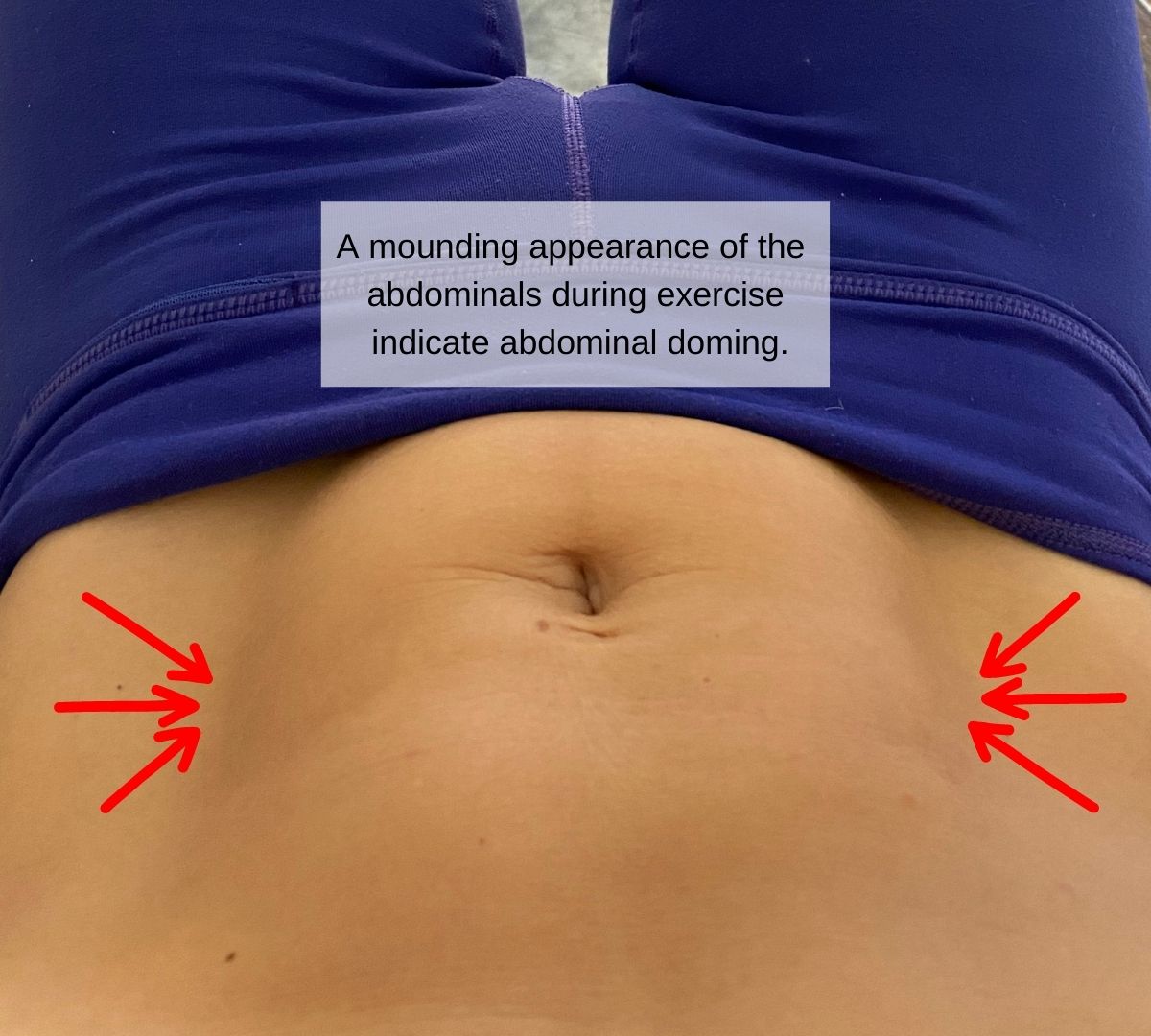What does diastasis look like? 